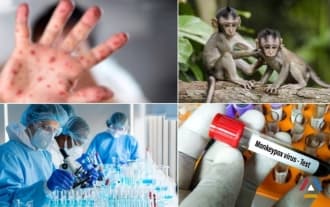 First case of monkeypox virus confirmed in Georgia